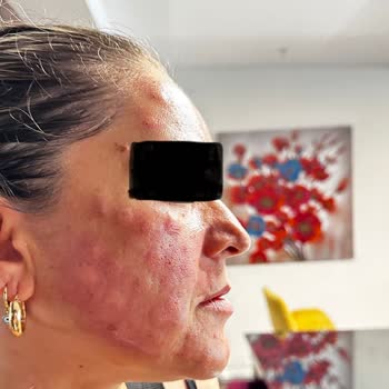 Reyap Hastanesi Cildiye Bölümü Mağduriyet