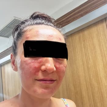 Reyap Hastanesi Cildiye Bölümü Mağduriyet