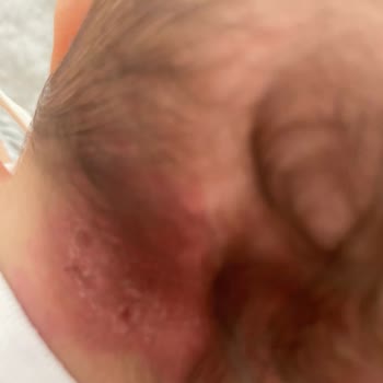 Babyjem Düz Kafa Yastığı Bebeğin Kafasını Yara Yaptı