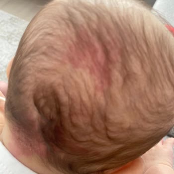 Babyjem Düz Kafa Yastığı Bebeğin Kafasını Yara Yaptı