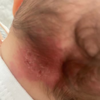 Babyjem Düz Kafa Yastığı Bebeğin Kafasını Yara Yaptı