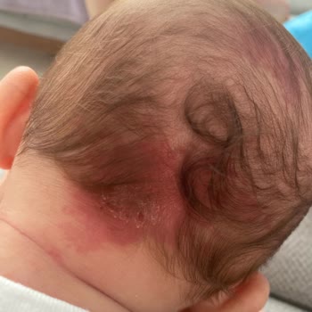 Babyjem Düz Kafa Yastığı Bebeğin Kafasını Yara Yaptı