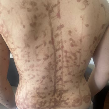 Noora Life Beauty Center Lazer Epilasyon Sırasında Yaktılar