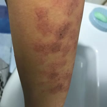 Özlem Ateş Güzellik Merkezi Lazer Sırasında 2. Derece Yanık