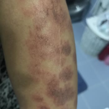 Özlem Ateş Güzellik Merkezi Lazer Sırasında 2. Derece Yanık