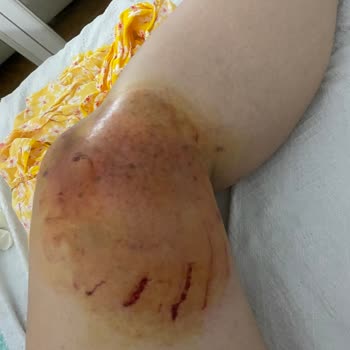 Çiğli Ege Spa & Hamam Jakuzide İhmal Yüzünden Yaralandım