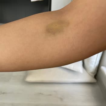 ParkHayat Afyon Hastanesi Park Hayat Hastanesi Kollarımı Mosmor Etti