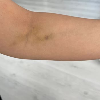 ParkHayat Afyon Hastanesi Park Hayat Hastanesi Kollarımı Mosmor Etti