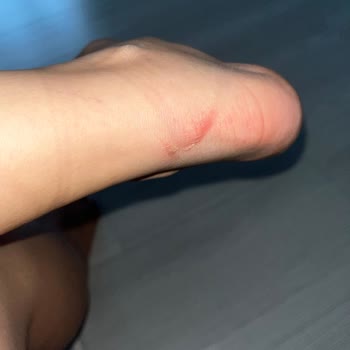 Bershka Sandalet Yara Yapıyor