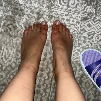 Bershka Sandalet Yara Yapıyor