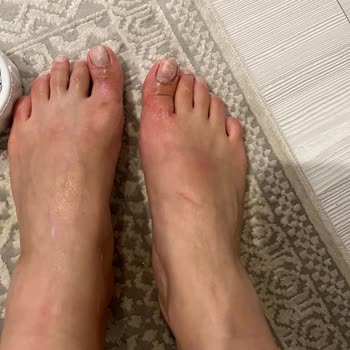 Bershka Sandalet Yara Yapıyor