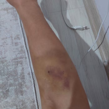Türk Kızılay Kan Verdim Kolum Bir Haftadır Mosmor