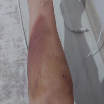 Türk Kızılay Kan Verdim Kolum Bir Haftadır Mosmor