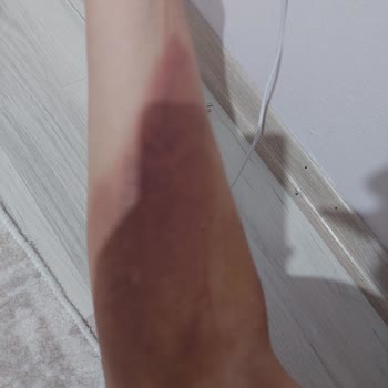 Türk Kızılay Kan Verdim Kolum Bir Haftadır Mosmor