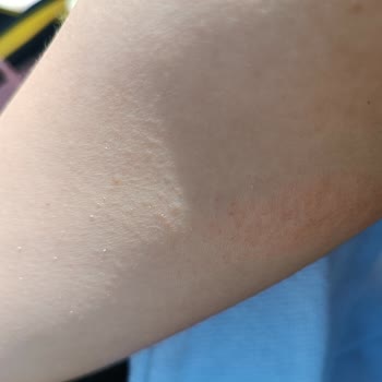 Sebamed Güneş Kremi Alerji Yaptı