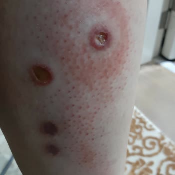 Gülhane Eğitim Ve Araştırma Hastanesi (GATA) Asistanlar Sayesinde Cüzzam Hastaları Gibi Geziyorum