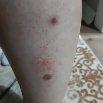 Gülhane Eğitim Ve Araştırma Hastanesi (GATA) Asistanlar Sayesinde Cüzzam Hastaları Gibi Geziyorum
