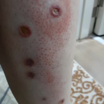 Gülhane Eğitim Ve Araştırma Hastanesi (GATA) Asistanlar Sayesinde Cüzzam Hastaları Gibi Geziyorum