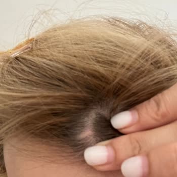 Salon Mahmut Karataş Saçlı Deriye Verilen Hasar Ve Telafi Edilmemesi