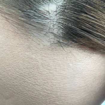 Salon Mahmut Karataş Saçlı Deriye Verilen Hasar Ve Telafi Edilmemesi