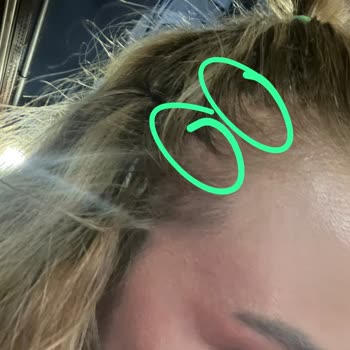 Salon Mahmut Karataş Saçlı Deriye Verilen Hasar Ve Telafi Edilmemesi