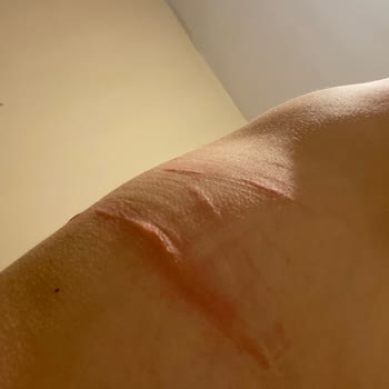 Penti Sütyen İçindeki İnce Silikon Cildimi Kesti Üstüne Kabarttı!