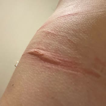 Penti Sütyen İçindeki İnce Silikon Cildimi Kesti Üstüne Kabarttı!