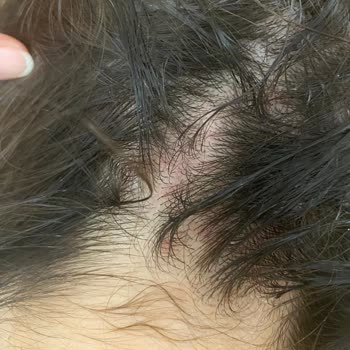 Yves Rocher Şampuan Saç Derimde Yara Yaptı