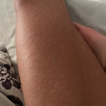 Eda Taşpınar Bronzlaşma Bombası Alerji