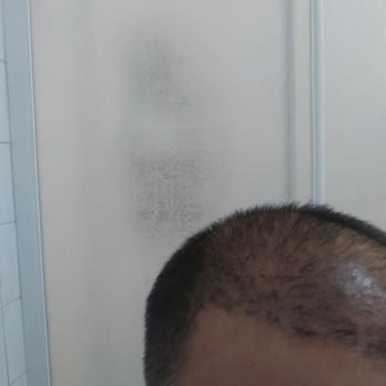 İstanbul Hairline Az Greft Ve Kolaya Kaçma