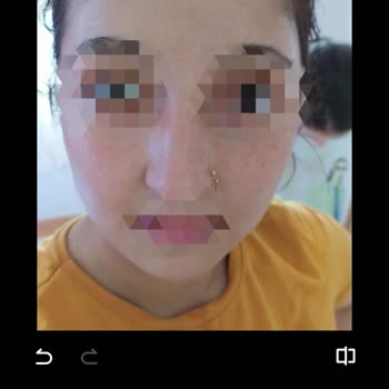 Claderm Yüzümü Kıpkırmızı Yaktı