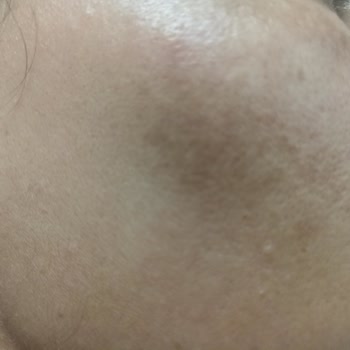 Reyhan Şefikoğlu Beauty & Consultany Cilt Yanması Delinmesi