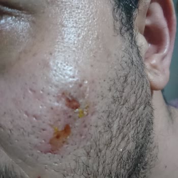 Reyhan Şefikoğlu Beauty & Consultany Cilt Yanması Delinmesi