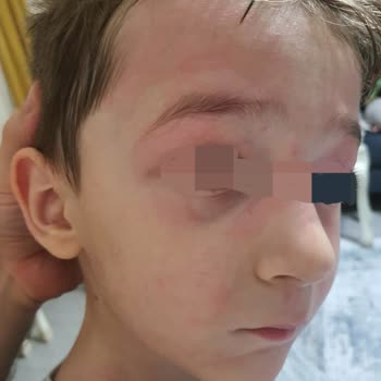 Eyüp Sabri Tuncer Gül Suyu Cildi Yaktı Tahriş Etti!