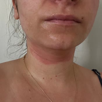 Yves Rocher Hatalı Ürün Tavsiyesi İle Cilt Reaksiyonu