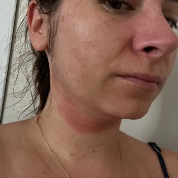 Yves Rocher Hatalı Ürün Tavsiyesi İle Cilt Reaksiyonu