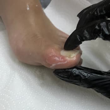 SuperStep'ten Alınan Converse Ayakkabıların Ayağı Mahvetmesi