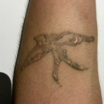 Estemol Estetik ve Güzellik Dövme Silme Yanık İzi Meydana Geldi Hiç İyi Sonuçlar Alamadım