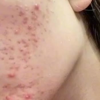 Cream Co. Nemlendirici Kullanımı Sonrası Sivilce Problemi