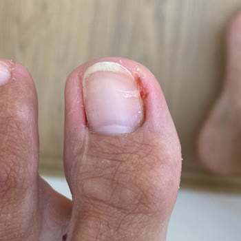 Coiffeur Kübra'da Manikür Pedikürden Sonra İltihaplanma