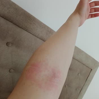 Sesu Sesi Tüy Dökücü Sprey Yan Etkisi