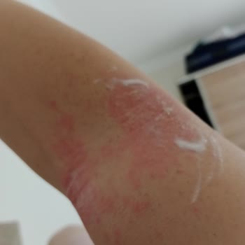 Sesu Sesi Tüy Dökücü Sprey Yan Etkisi