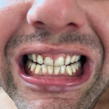 Çekmeköy Ağız Ve Diş Sağlığı Merkezi Diş Hekimi Diş Taşlarımı Tam Olarak Temizlemedi