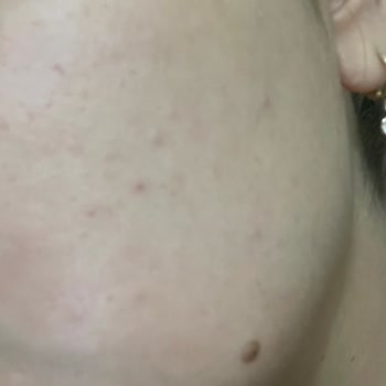 Yves Rocher Sebo Vegetal Jel Krem Yüzümü Mahvetti