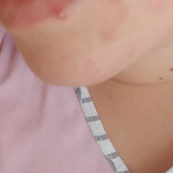 La Roche Posay Yüz Temizleme Köpüğü Cildimde Kırmız Leke Yaptı