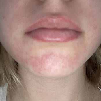 Clinique Testerı Cildimi Mahvetti!