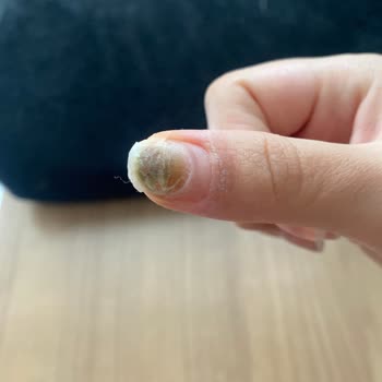 Beauty Seher Ergün Protez İşlemi Sonrası Tırnağım Morardı Ve İşletme Sahibi Hakaret Etti