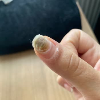 Beauty Seher Ergün Protez İşlemi Sonrası Tırnağım Morardı Ve İşletme Sahibi Hakaret Etti