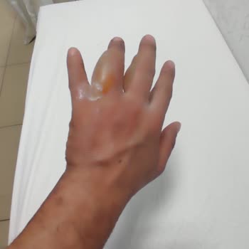 Yertaş Havai Fişek Yüzünden 2. Derece Yanık
