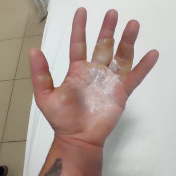 Yertaş Havai Fişek Yüzünden 2. Derece Yanık